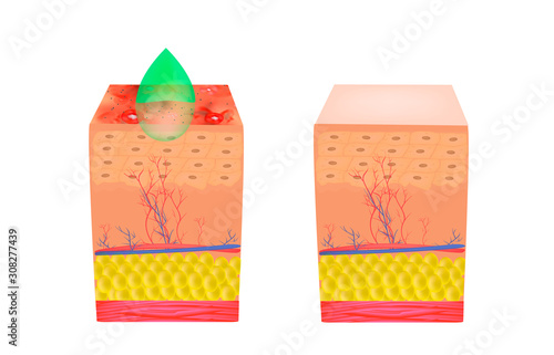 peeling for acne. Inflamed skin acne. Acne purulent. The anatomical structure of the skin. Infographics. Vector illustration on isolated background.