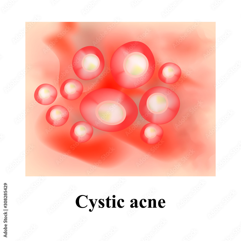 Acne Pustules