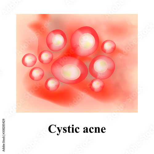 Pustules on the skin. Cystic acne. Pimples on the skin. Infographics. Vector illustration.