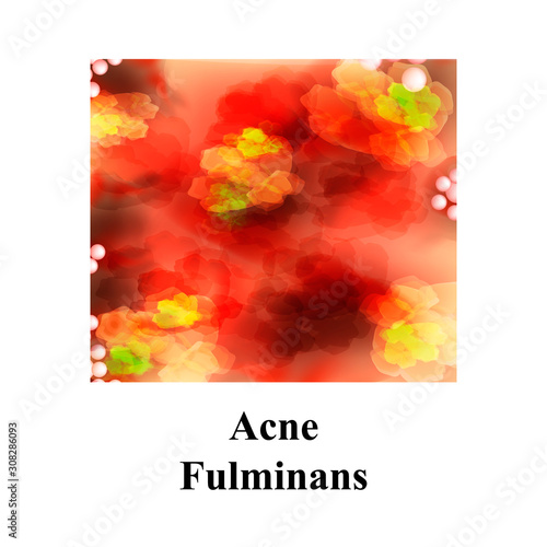 Pustules on the skin. Acne Fulminans. Cystic acne. Pimples on the skin. Furuncle. Infographics. Vector illustration.