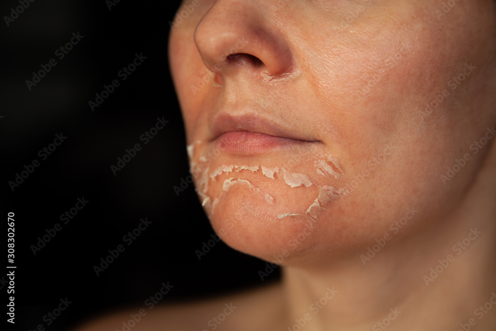 Woman's face after chemical peeling. Peeling skin on the face