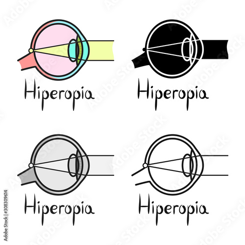 Vector design of hyperopia and eyeball symbol. Web element of hyperopia and eye stock vector illustration.