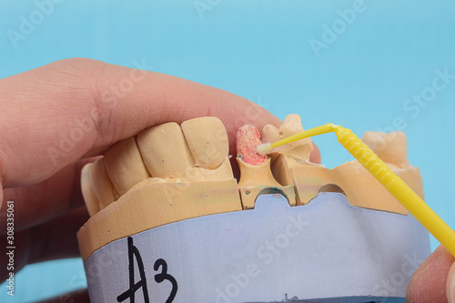 plaster models of the jaws in the hands of a dental technician in a dental laboratory, manufacturing dental prostheses photo