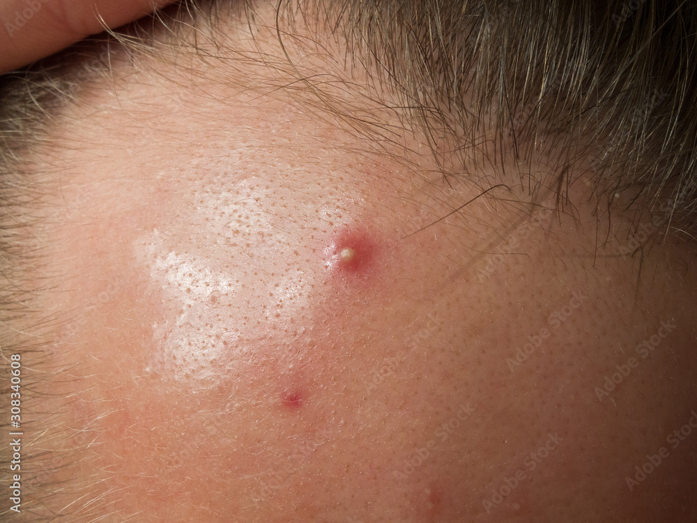 Fototapeta premium pimple on the forehead close-up, acne