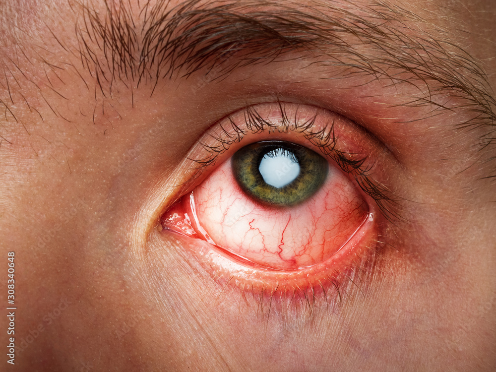 conjunctivitis, conjunctival inflammation, red eyes, infection and inflammation, close up eye - obrazy, fototapety, plakaty 