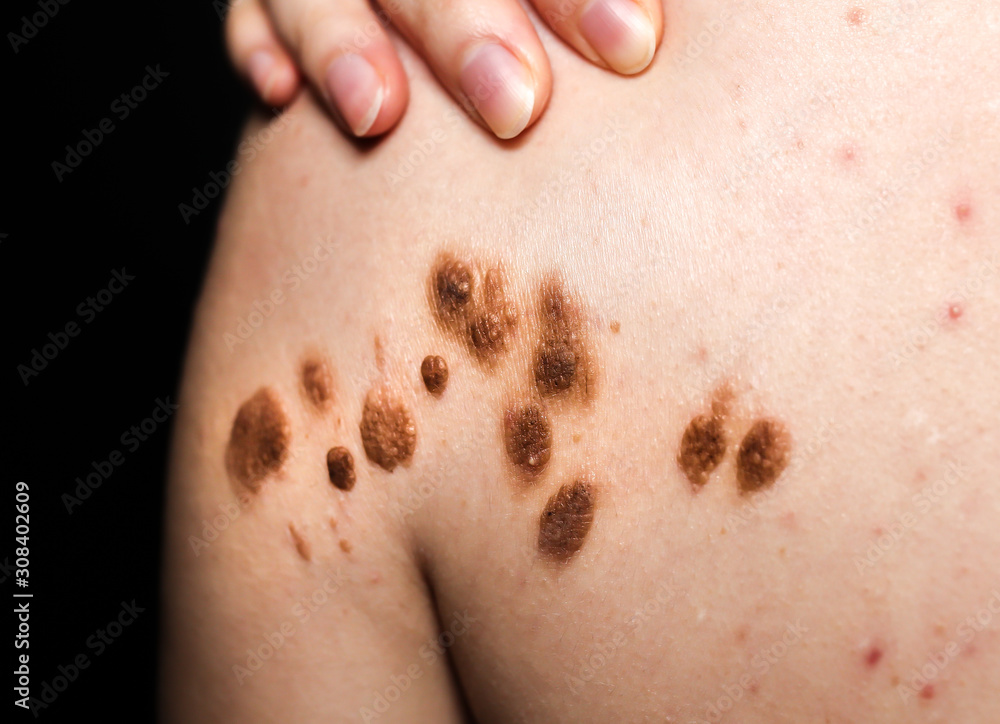 Fototapeta premium Big birthmarks and freckles on the girl's skin. Medical health photo of back. Woman's oily skin with problems acne.