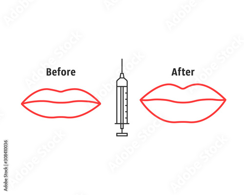 before and after lips filler injections