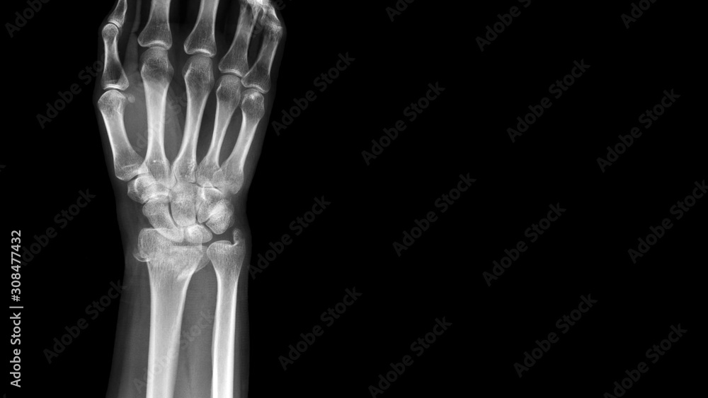 Film X ray wrist radiograph show distal forearm bone broken ( distal end radius fracture). The patient has wrist pain, swelling and deformity. Medical imaging for investigation and technology concept Film X ray wrist radiograph show distal forearm bone broken ( distal end radius fracture). The patient has wrist pain, swelling and deformity. Medical imaging for investigation and technology concept