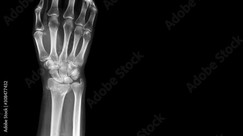 Film X ray wrist radiograph show distal forearm bone broken ( distal end radius fracture). The patient has wrist pain, swelling and deformity. Medical imaging for investigation and technology concept photo