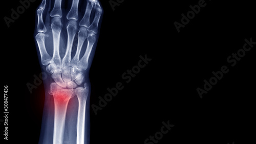 Film X-ray wrist radiograph show lower end of forearm bone broken (distal end radius fracture) from traffic accident. Highlight on broken site and painful area.  Medical imaging and technology concept photo