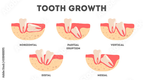 Set of human teeth in diffrent condition. Dental health and disease concept. photo