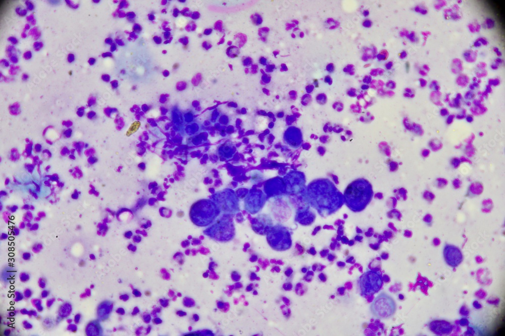 Mononuclear and multinucleated cell (Tzanck smear ,Abnormal Human cells , Medical technologist) Mononuclear and multinucleated cell (Tzanck smear ,Abnormal Human cells , Medical technologist)