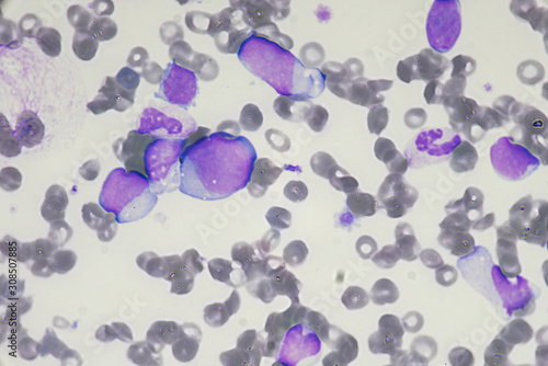Acute myeloid leukemia (Blast cell , Whote blood cells)