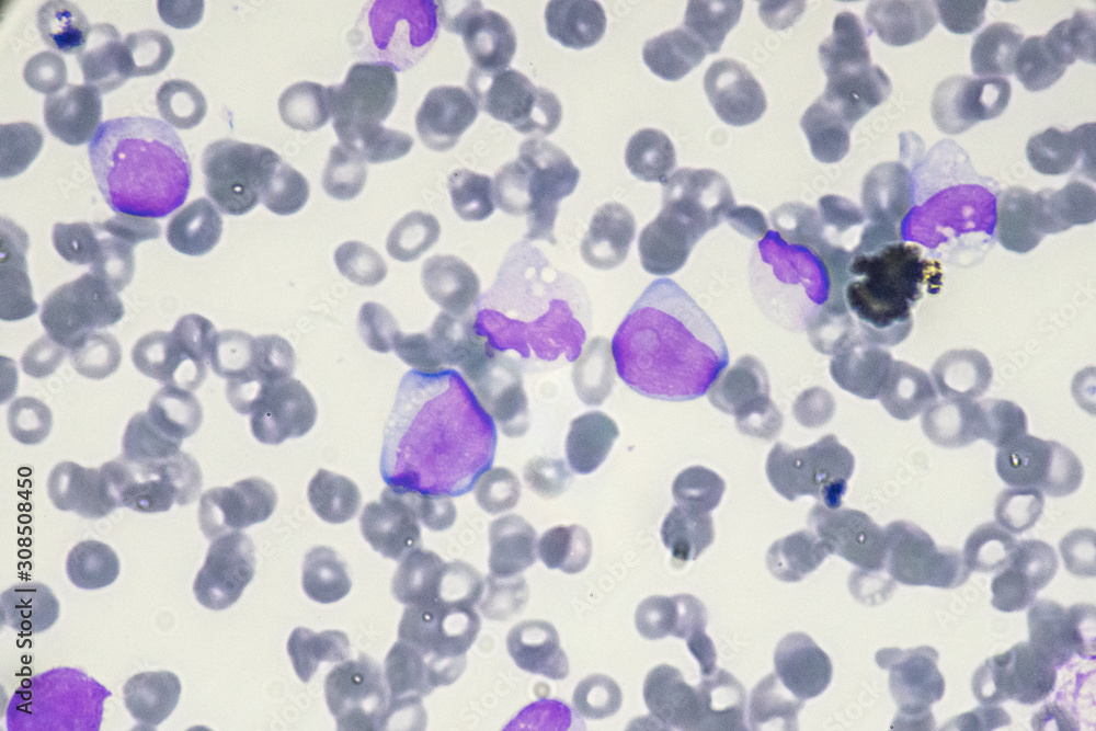 Blast cell in Acute myeloid leukemia from human blood cells (White ...