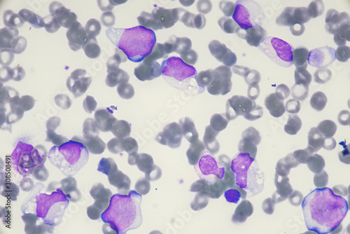 Blast cell in Acute myeloid leukemia from human blood cells (White blood cells cancer , Bone marrow aspirate)