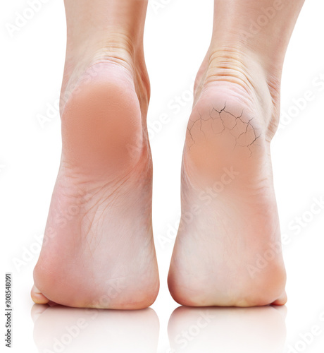 Female feet with cracks and dry skin on heels before and after treatment.