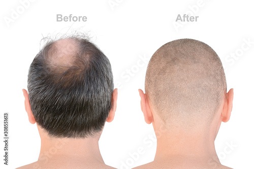 Hair loss. Before and after transplantation. Rear view of male bald head on white background, isolated