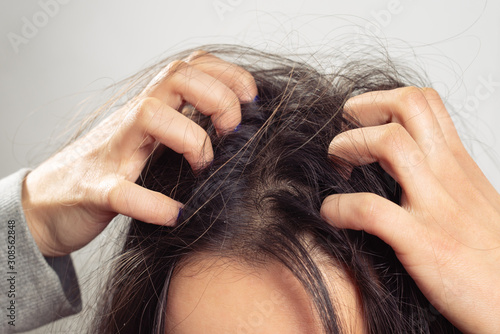 Closeup woman hand itchy scalp, Hair care concept photo