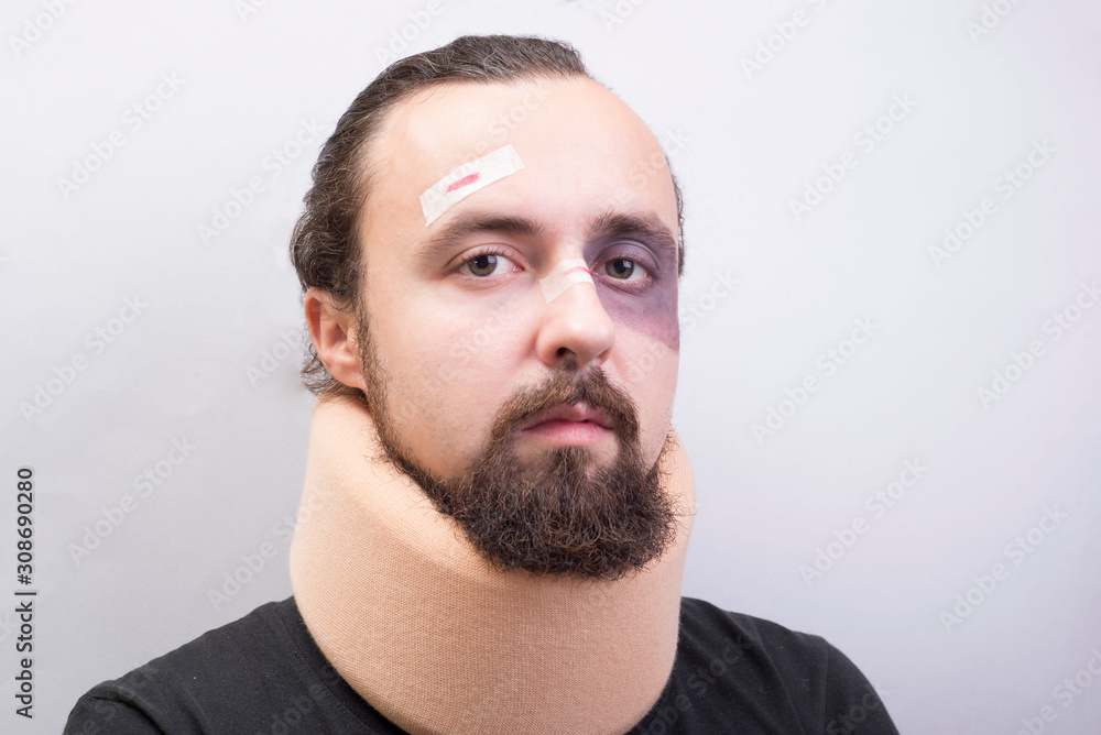 Fototapeta premium Closeup portrait of a young guy with bruises on his face, with a neck injury. The collar is placed in the neck to immobilize the cervical vertebrae.