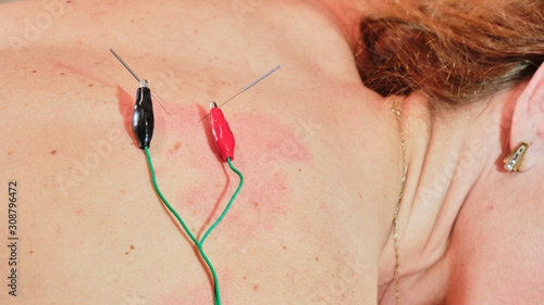 Obraz na płótnie Acupuncture needles treatment with electrical wires / stimulator on Caucasian skin. Traditional Chinese acupuncture and modern Electro acupuncture concept. w salonie