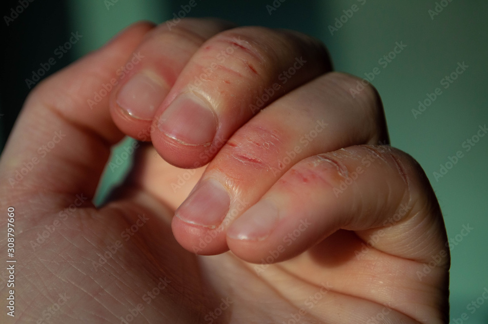 Manicures trigger rash, allergic reaction: 'Lifelong consequences'