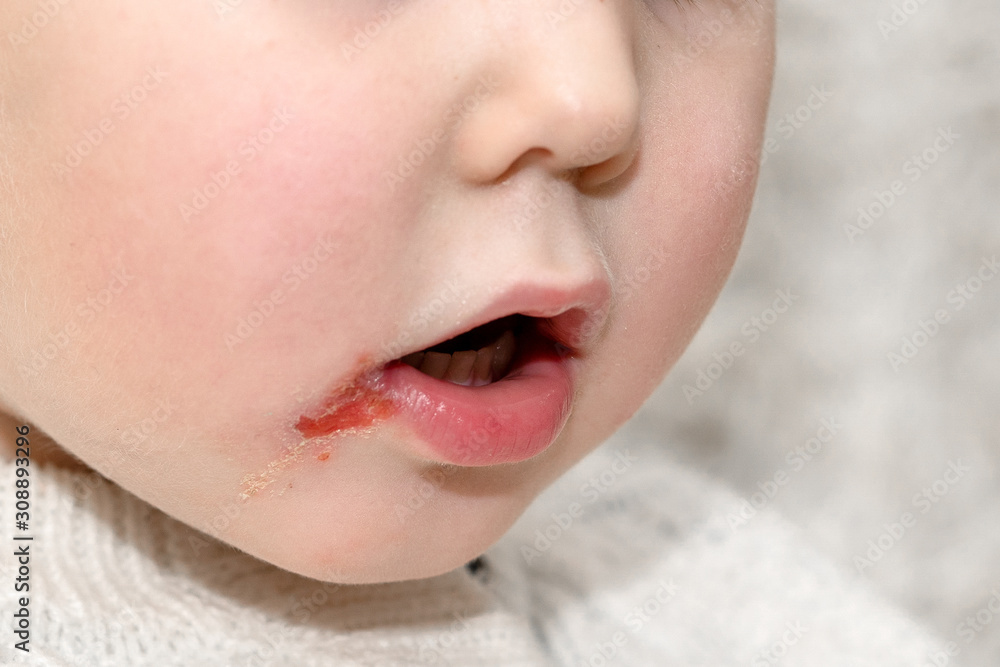 Herpes on upper lip of a little girl. Wound on the face of a schoolboy. Inflammation of the lip