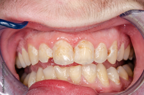 intraoralaufnahme der frontzähne mit gingivitis und zahnbelag
