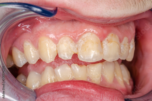 intraoralaufnahme der frontzähne mit gingivitis und zahnbelag