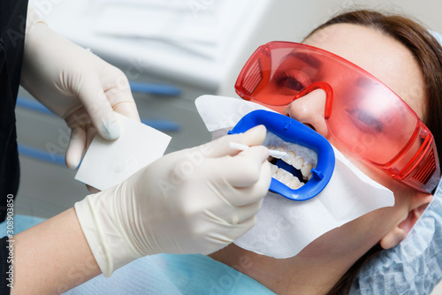 Preparing the oral cavity for whitening with an ultraviolet lamp. Close-up
