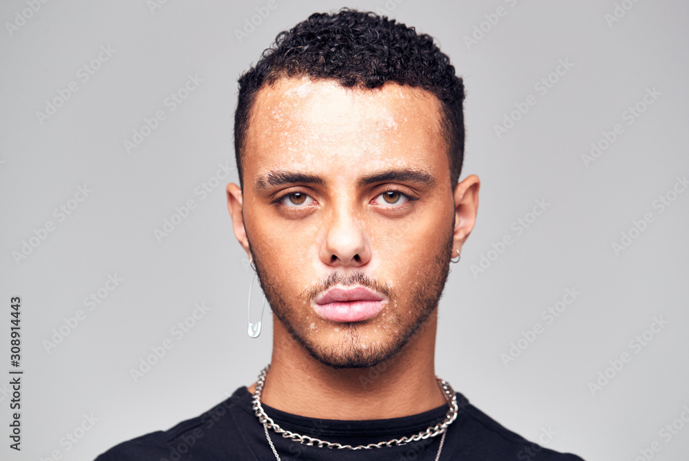 Obraz premium Studio Portrait Of Young Man With Skin Pigmentation Disorder Looking At Camera