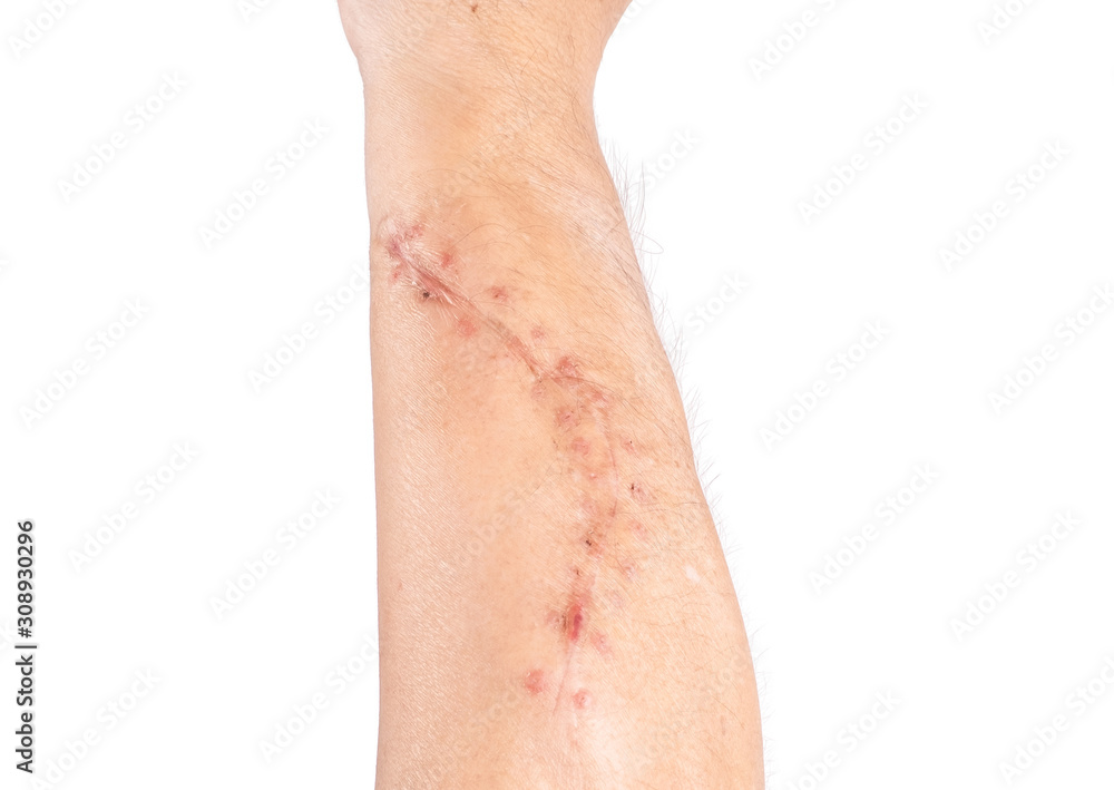 Surgical wound on the arm,isolated on white background. Surgical wound on the arm,isolated on white background.