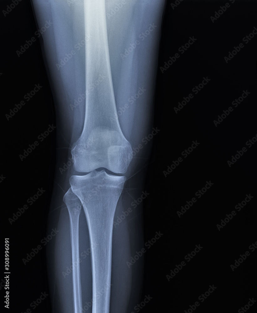 x ray of the knee joint , medical diagnostics, traumatology and orthopedics x ray of the knee joint , medical diagnostics, traumatology and orthopedics