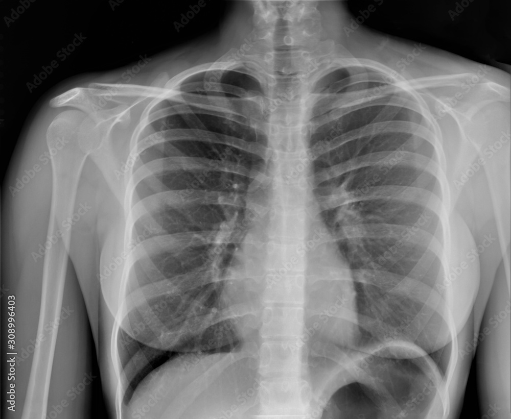 chest xray, pneumonia, emphysema, pulmonology, diagnosis of diseases