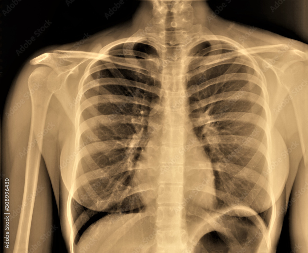 chest x-ray, pneumonia, emphysema, pulmonology, diagnosis of diseases chest x-ray, pneumonia, emphysema, pulmonology, diagnosis of diseases