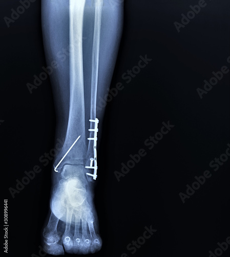 the x-rays of intramedullary osteosynthesis in the fracture of the tibia,implant