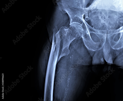  x-ray of hip joint with femoral neck fracture, traumatology and orthopedics