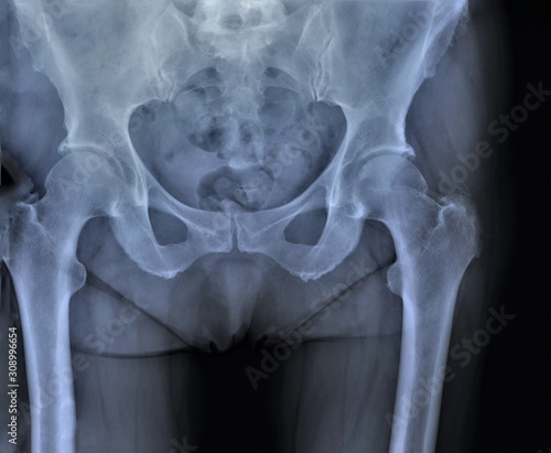 x-ray of pelvic bones and hip joints in direct projection, coxarthrosis, osteoporosis, medical research photo