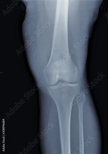 x ray of the knee joint , medical diagnostics, traumatology and orthopedics © Anton
