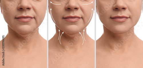 Mature woman before and after plastic surgery operation on white background, closeup. Double chin problem photo