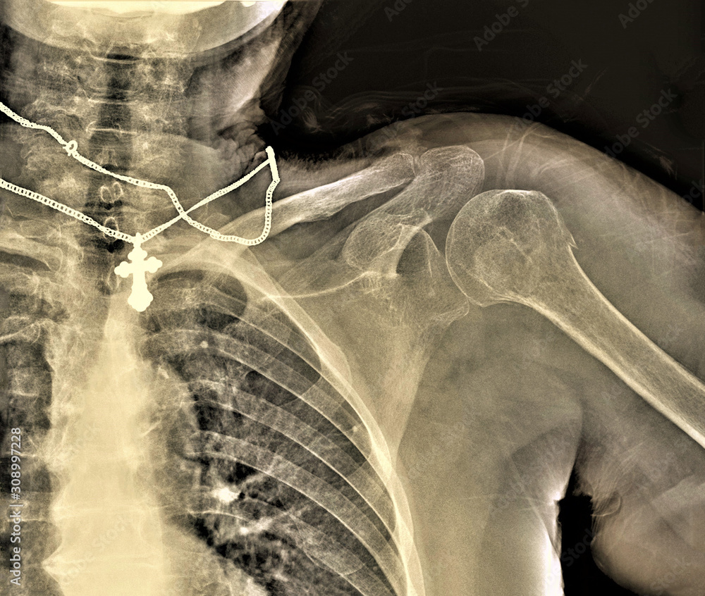 x-ray of the shoulder joint of an adult male, medical diagnosis, examination x-ray of the shoulder joint of an adult male, medical diagnosis, examination