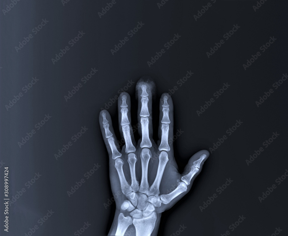 x-ray of hand bones, diagnosis of diseases x-ray of hand bones, diagnosis of diseases