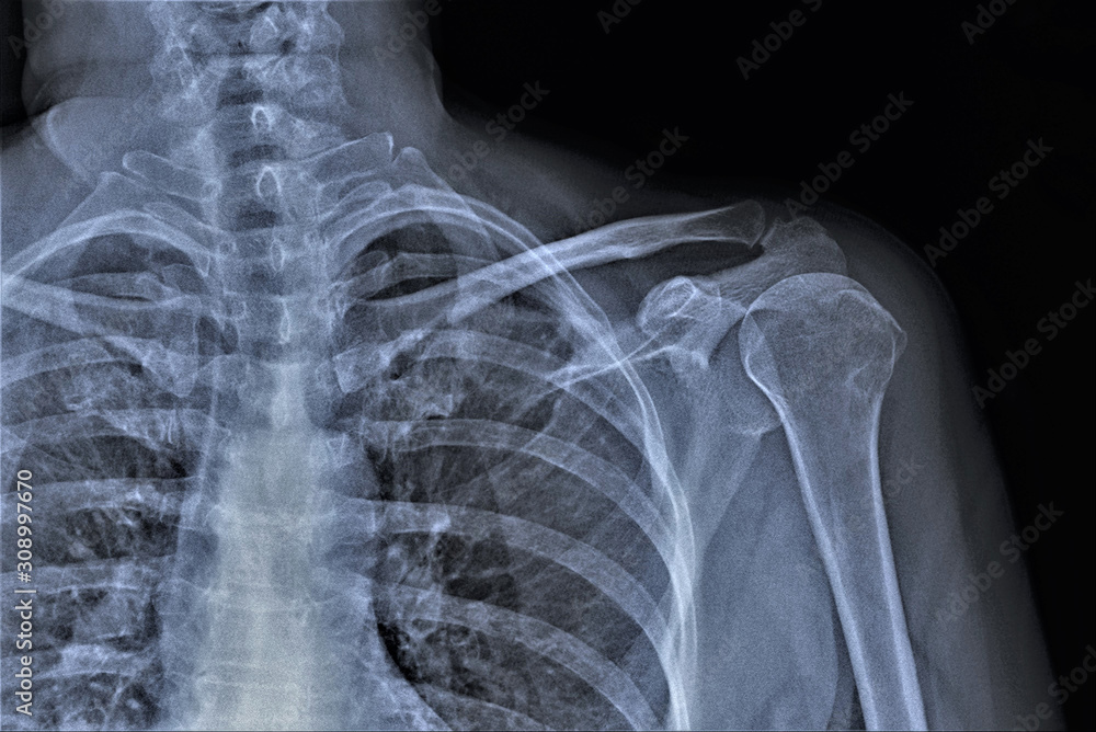 xray of the shoulder joint of an adult male, medical diagnosis