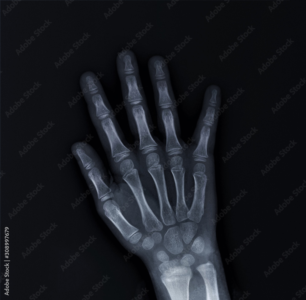 x-ray of hand bones, diagnosis of diseases x-ray of hand bones, diagnosis of diseases