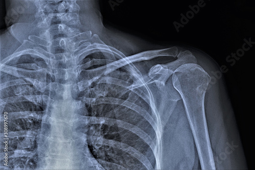x-ray of the shoulder joint of an adult male, medical diagnosis, examination