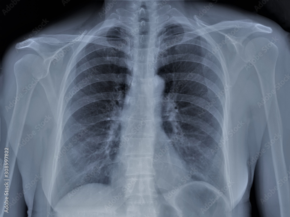 chest x-ray, pneumonia, emphysema, pulmonology, diagnosis of diseases chest x-ray, pneumonia, emphysema, pulmonology, diagnosis of diseases