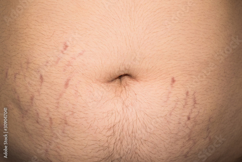 A man is overweight all over his body, on his stomach, chest, arms. Stretch marks on the abdomen in the process of losing weight. photo