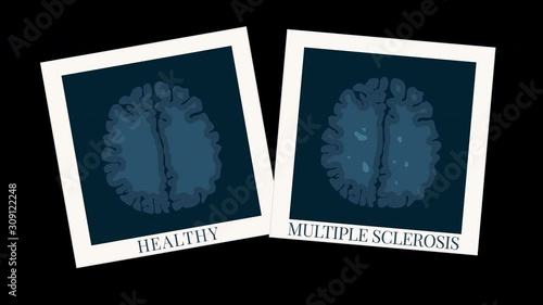 Multiple sclerosis motion graphics with MRI scan photo of healthy brain and one affected by MS. Central nervous system disease. Demyelinating disorder awareness. Medical concept animation with alpha 