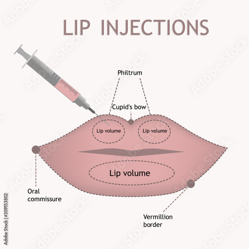 Lip injections scheme in flat style .Vector image of lip augmentation procedure with detailed anatomical zones info graphic. 