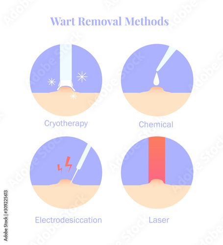 Infographics wart removal methods. Cryotherapy, Electrodesiccation, chemical and laser removal.