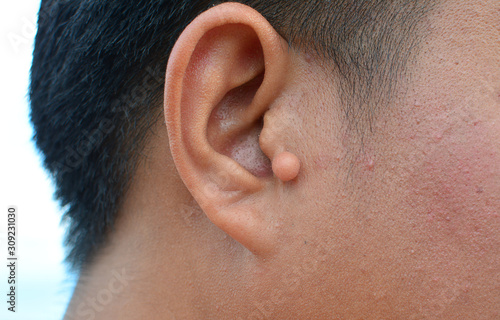 Scar Keloid ear ball shaped. hypertrophic scar on man ear. Can used for healthcare concepts.